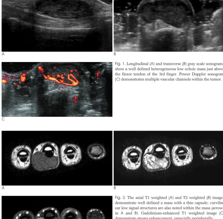Fig. 2. The axial T1 weighted (A) and T2 weighted (B) images demonstrate well defined a mass with a thin capsule;  curvilin-ear low signal structures are also noted within the mass (arrows in  A and  B)