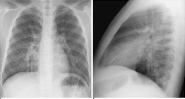 Fig. 1. A 10-year-old boy with laboratory confirmed S-OIV (H1N1) who presented with coughing.