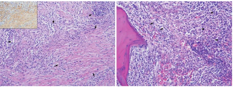 Fig. 1. F. Microscopically, there is fascicular proliferation of plump spindle cells featuring myofibroblast (arrows) and inflammatory infiltrates mainly composed of plasma cells (arrow heads) (H &amp; E, ×200)
