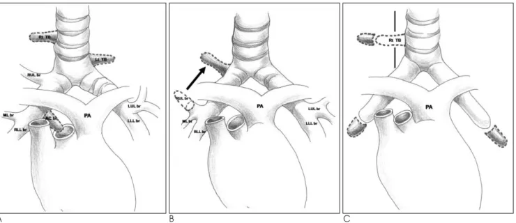 Fig. 2. Tracheal bronchus: An anomalous bronchus from lower trachea.