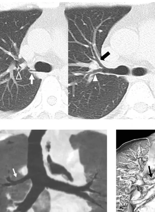 Fig. 5. Tracheal bronchus: Right upper lobe bronchus from tra- tra-cheal bifurcation. 