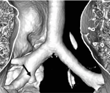 Fig.  6.  Tracheal bronchus: Double right upper lobe bronchi from right main bronchus.