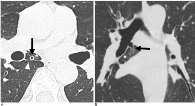 Fig. 9. Cardiac bronchus with own accessary lobe. 