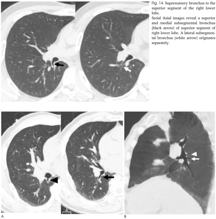 Fig. 15. Supernumery bronchus to the superior segment of the right lower lobe. 