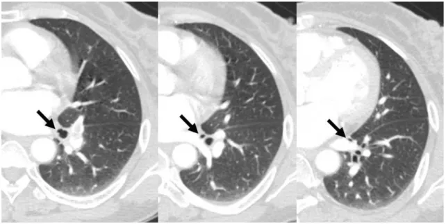 Fig. 16. Medial basal segmental bronchus of left lower lobe: an independent origin.