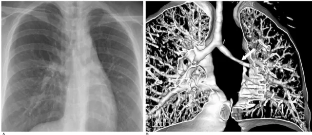 Fig. 18. Agenesis of left upper lobe in a 35-year-old woman.
