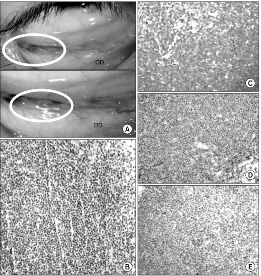 Fig. 1. Clinical appearance (A) and  Immunohistochemical  staining   pro-perties (B-D)