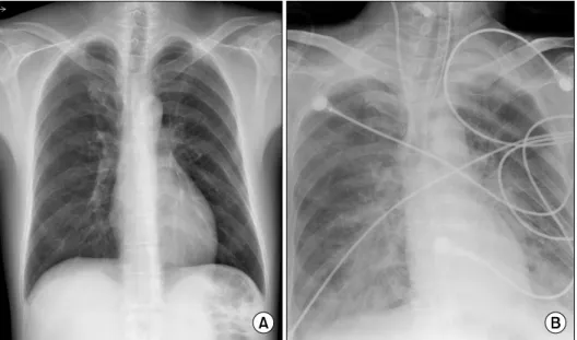 Fig. 2. The chest radiograph showed no active lung lesion (A), and acute pulmonary infiltration in both lung  fields (B).