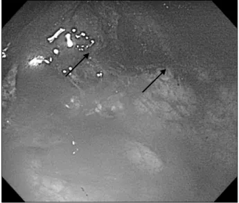 Fig. 1. Gastrointestinal endoscopy showed a huge amount of grey colored  elevated  necrotic  debris  surrounded  by  erythematous  erosive mucosa from antrum to upper body (arrows).