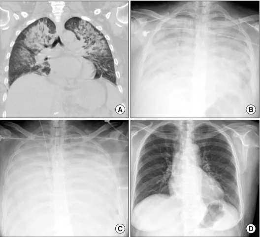 Fig. 1. Bilateral lung opacities deve- deve-loped after liver transplantation. (A) As  shown  in  the  chest  computed  tomography image, bilateral  consoli-dation  was  initially  seen   predomi-nantly in both the upper lobes  (pos-toperative day [POD] 5)