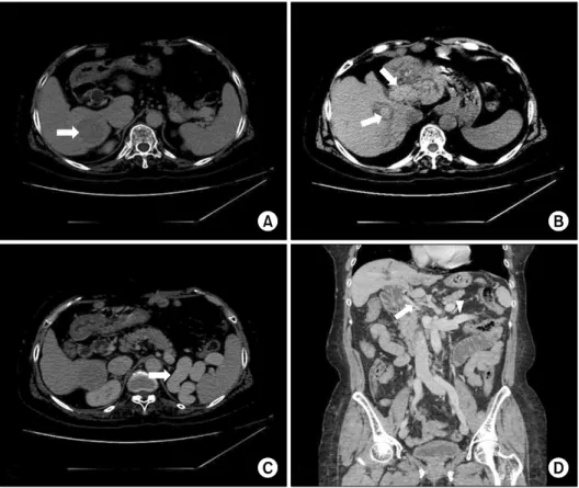 Fig. 1. Abdominal computed tomo- tomo-graphy performed 2 months before  living  donor  liver  transplantation  showed a new hepatic mass,  intra-hepatic duct (IHD) stones, a large  splenorenal shunt (SRS), and  oblite-rated portal vein