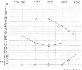 Fig.  2.  Pure  tone  audiogram.
