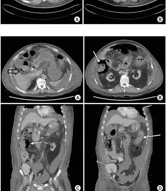Fig. 1. Abdominopelvic computed to- to-mography scan. Ascites and (A) mild to  (B)  moderate  symmetrical  wall  thickening (arrows) was observed on the ascending colon.