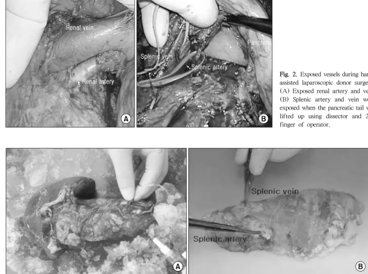 Fig. 2. Exposed vessels during hand- hand-assisted laparoscopic donor surgery. 