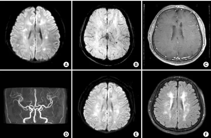 Fig. 1. Initial magnetic resonance imaging (MRI) including (A) diffusion-weighted sequence and (B) susceptibility-weighted sequence shows multiple infarctions involving bilateral corona radiata