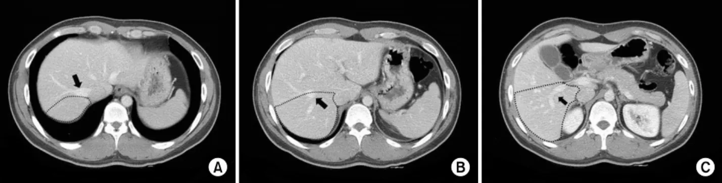 Fig. 1. Right posterior sector (RPS) graft contours (dots) on axial computed tomography images