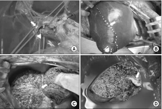 Fig. 3. A  operation  field  of  RPS  graft procurement. (A) Hilar  disse-ction for identifying the right  pos-terior  hepatic  artery  (arrow)  and  portal  vein  (arrowhead)