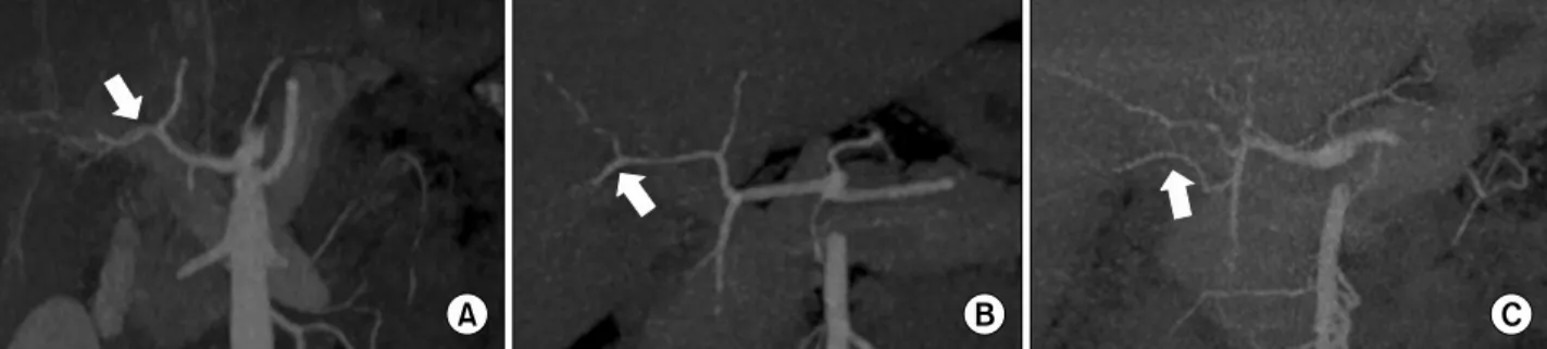 Fig. 4. Anatomical right posterior hepatic artery (PHA) variations according to preoperative three-dimensional computed tomography