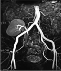 Fig. 1. Allograft biopsy shows diffuse infiltration of lymphocytes along the interstitium and tubulitis (arrows) (PAS, ×400).
