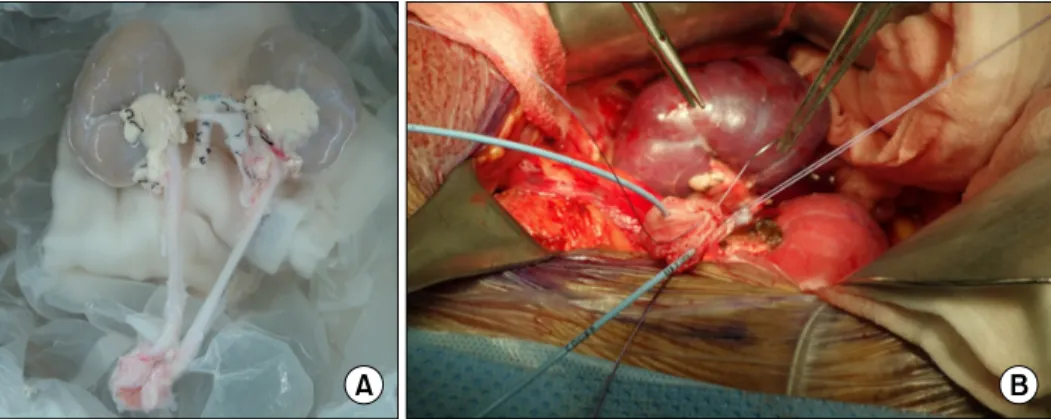 Fig. 1. (A) Pediatric  en bloc  kidneys with  ureters  and  partial  bladder  segment