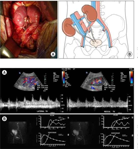 Fig. 2. (A,  B)  Implantation  of  en bloc  kidneys with partial  bla-dder segment.
