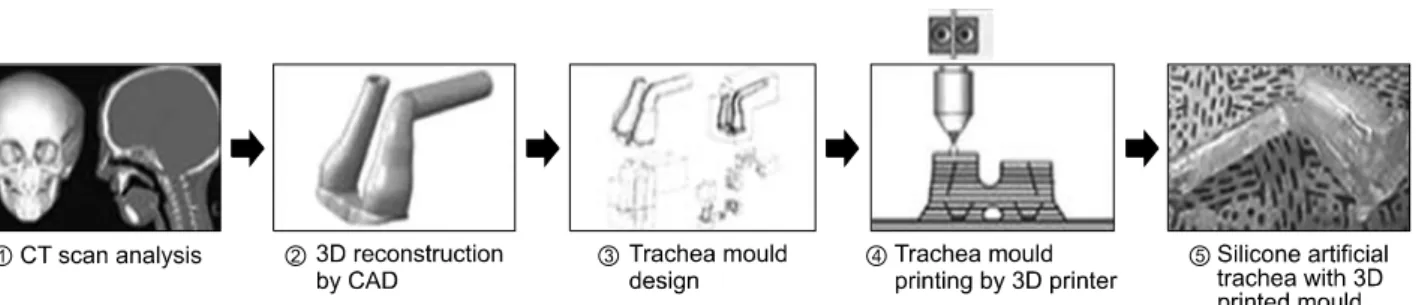 Fig. 6. Implanted 3D Printing nostril stent. Reprinted from Fig. 6 of reference [4].