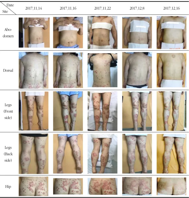 Fig. 1. Changes in Psoriasis According to Treatment Duration