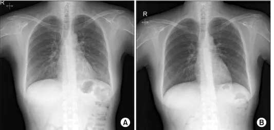 Fig. 1. (A) On admission day, chest posteroanterior (PA) shows diffusely increased density in both lower lung zone