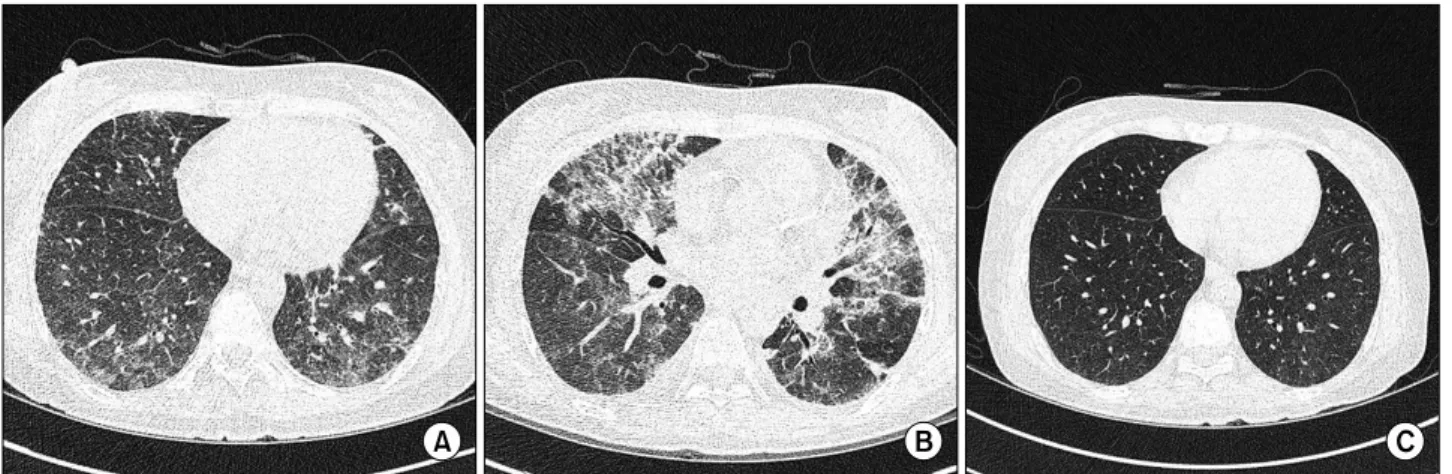 Fig. 2. (A) High resolution computed tomography (HRCT) on admission shows diffuse ground glass opacity (GGO) of lower lung  predominance