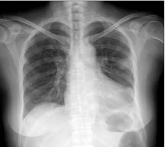 Fig. 2. (A)  Chest  computed  tomography  (CT)  revealed  contrast  enhanced  nodular  consolidations  in  right  upper  lobe  apical  and  left  upper  lobe  apicoposterior  segment