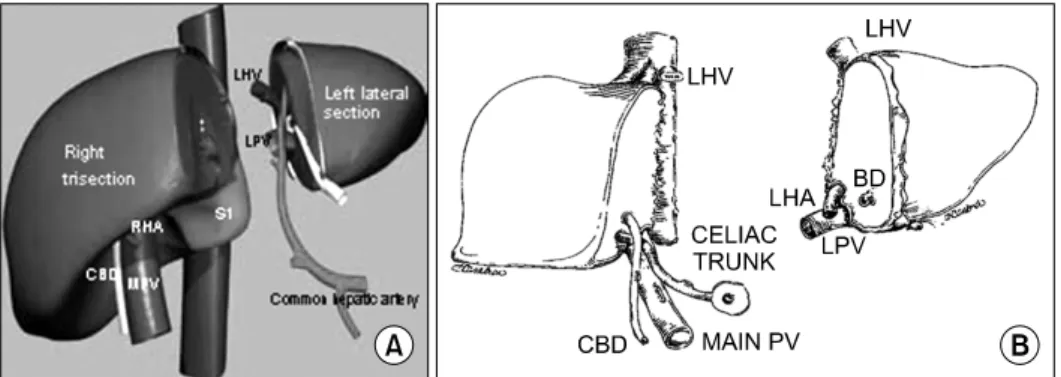 Fig. 3. Split  liver  transplantation  of  left  lateral  section  and  right  trisection
