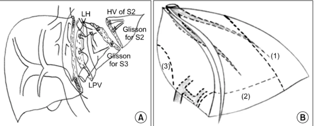 Fig. 4. Reduced left lateral section. (A) Monosegment (Segment 3). Reprinted from reference (22)