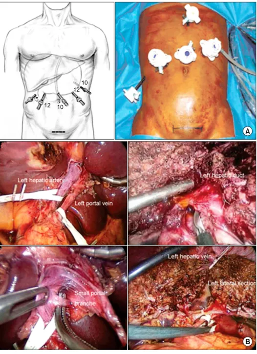 Fig. 5. Laparoscopic  left  lateral  sectionectomy  in  a  live  donor.  (A)  Port  placement  (n=port  size,  mm)  for laparoscopic left lateral  sectio-nectomy  in  a  live  donor