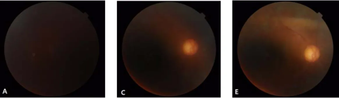 Fig. 4. (A, C, E) Progress of absorption of vitreous hemorrhage in right eye. 