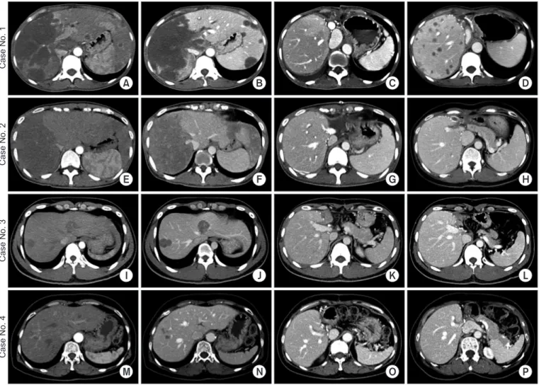 Fig. 1. Pretransplant and posttransplant computed tomography (CT) findings. Case No. 1 (A-D): pretransplant (A) arterial-phase and (B) portal-phase CT  images show a large tumor and small masses, along with involvement of the right portal vein branches