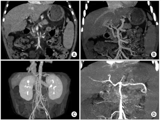Fig. 1. Pretransplant computed tomography  scan. (A-C) There is agenesis of the portal  vein with cavernous transformation and  sec-ondary portal hypertension with gastric and  esophageal varix