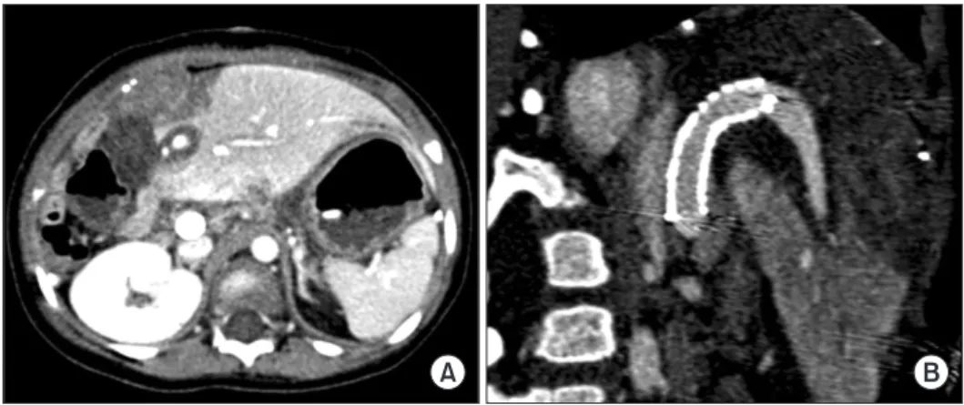 Fig. 5. Posttransplant computed tomography  scan taken at 2 days after transplantation