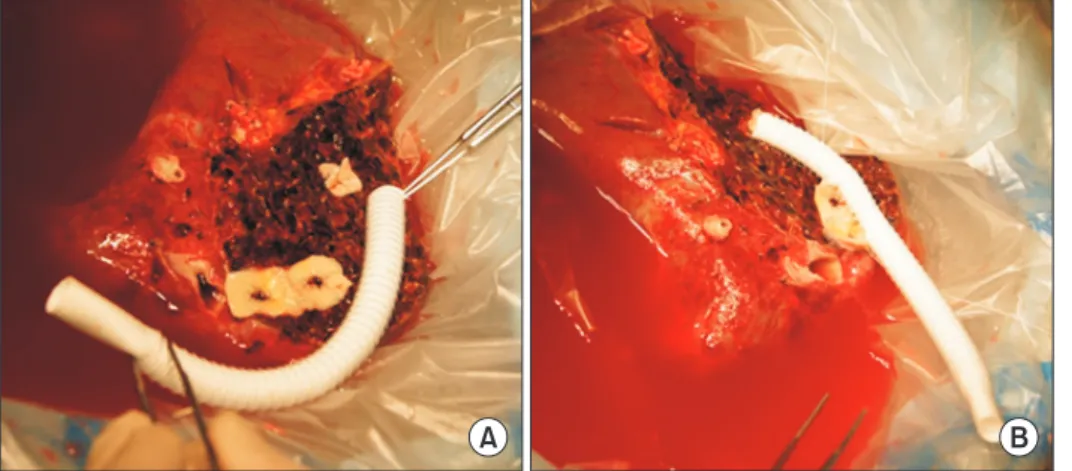 Fig. 1. Intraoperative photographs showing  the standardized techniques of middle  he-patic vein reconstruction using a composite  graft of ringed polytetrafluoroethylene  (PTFE) and cryopreserved iliac artery patch