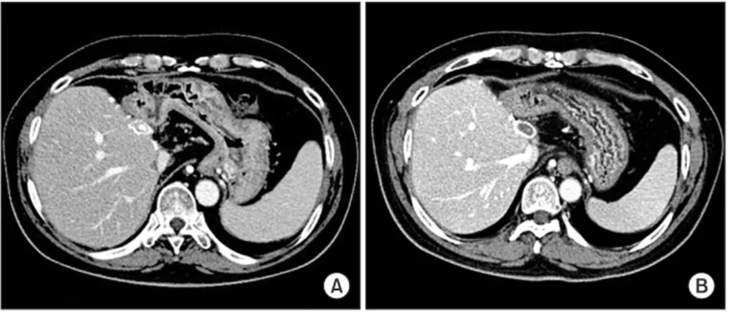 Fig. 2. Computed tomography images  showing progressive occlusion of the lumen  within the interposed  polytetrafluoroeth-ylene graft, taken after 3 months (A) and 6  months (B)