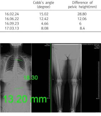 Table  1.  Change  of  Parameters  at  Before  and  After  Treatment  (Case  1) Cobb’s  angle (degree) Difference  of  pelvic  height(mm) 16.02.24 15.02 28.80 16.06.22 12.42 12.06 16.09.23 4.66 6 17.03.13 8.08 8.4