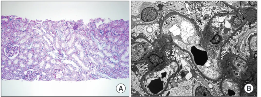 Fig. 1. Transplanted kidney biopsy. (A) Pe- Pe-riodic Acid Schiff stain, ×100. (B) Electron  microscopy, ×2,500