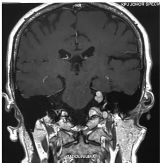 Fig.  2.  A  coronal  view  of  another  acoustic,  again  indenting  brainstem  on  L  side.