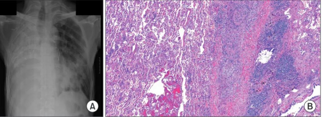 Fig. 2. (A) Chest computed tomography image obtained on postoperative day 21 after redo lung transplantation showing increased multiple patchy areas  of consolidation and ground-glass opacity on the left lower lung basal segment with a small amount of left