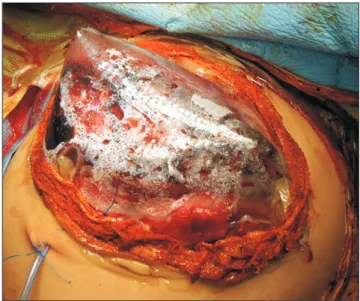 Fig. 5. Computed tomography scan taken four days after transplantation. There was an abdominal wall defect (A, B) but the configurations of the hepatic  vein (C) and portal vein (D) reconstruction were both smoothly streamlined.