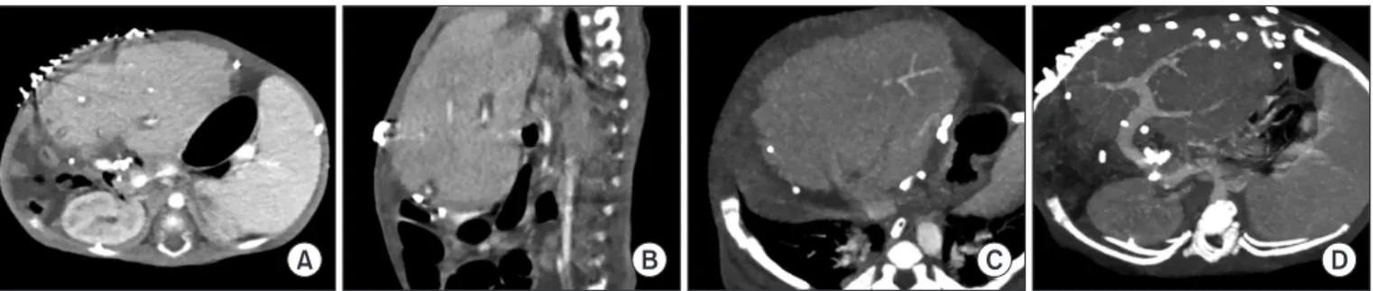 Fig. 6. Computed tomography scan taken 14 days after transplantation. The abdominal wall was closed completely (A, B) and the graft hepatic vein (C)  and portal vein (D) reconstructions were uneventful.