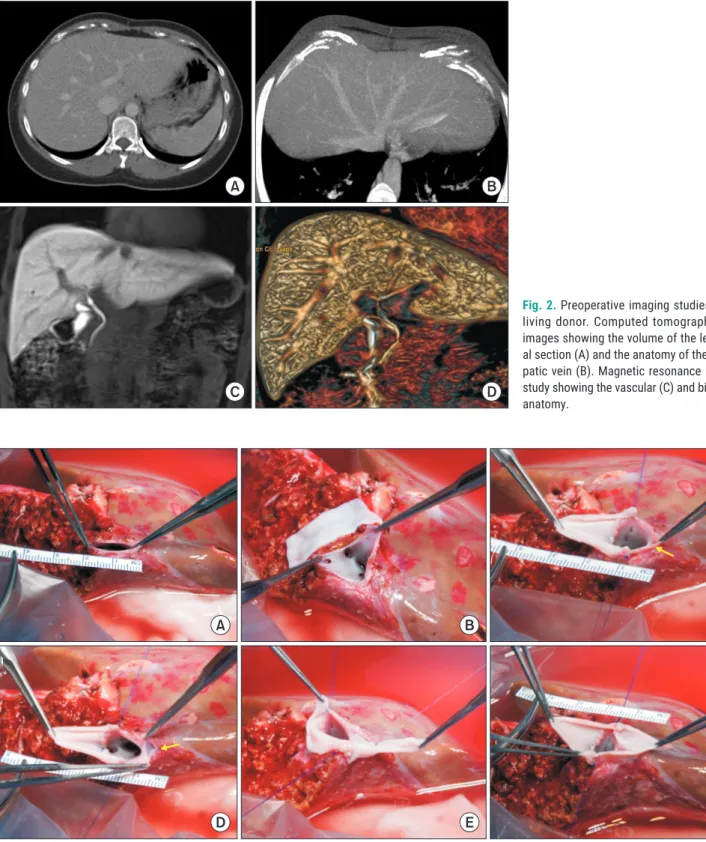 Fig. 3. Intraoperative photographs of the graft hepatic vein venoplasty at the back table