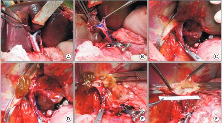 Fig. 4. Intraoperative photographs of the recipient hepatectomy. (A, B) We transected the right and left hepatic arteries at the highest level and transect- transect-ed the portal vein at the level of the second-order branch after marking the axis of the p