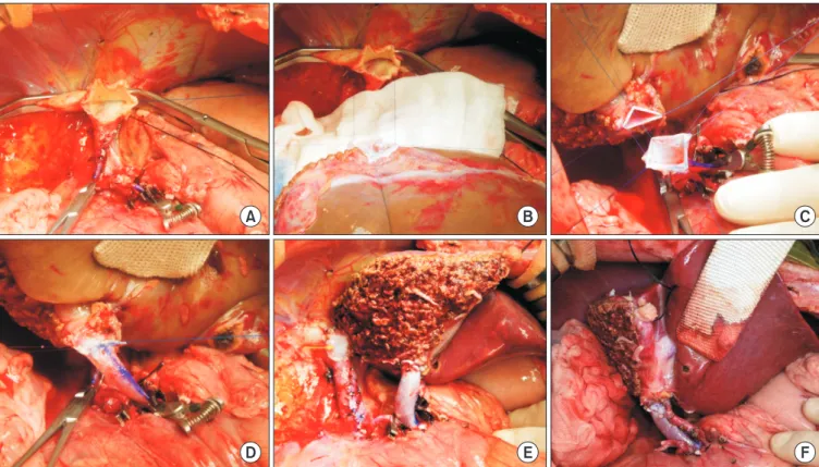Fig. 5. Intraoperative photographs of the graft implantation. (A, B) The right and left corners of the graft and recipient’s hepatic vein orifices were tagged  with 5-0 polydioxanone (PDS) and anastomosed with continuous sutures at the posterior and anteri