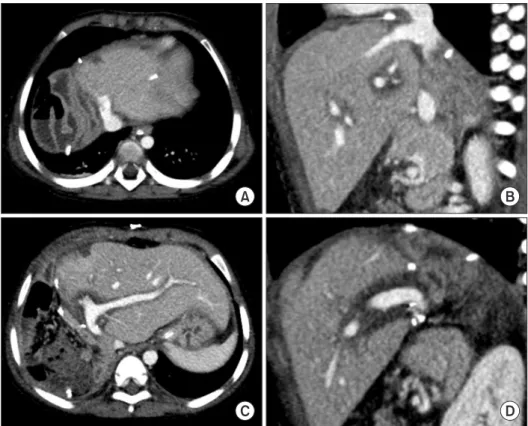 Fig. 6. Posttransplant computed tomogra- tomogra-phy scans taken 5 days after transplantation  showing smooth-streamlined reconstruction  of the hepatic (A, B) and portal (C, D) veins.