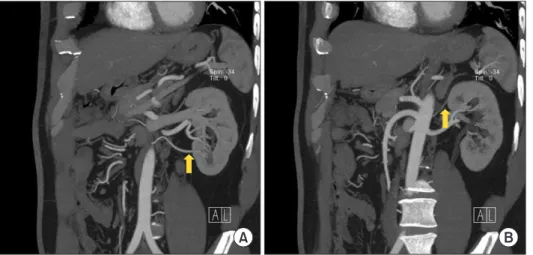 Fig. 1. Renal computed tomography an- an-giogram of the donor. A small lower polar  branch arises from the aorta (arrow),  supply-ing the lower pole (A) and a tiny upper polar  branch arises from the aorta (arrow),  supply-ing the upper pole of the left ki